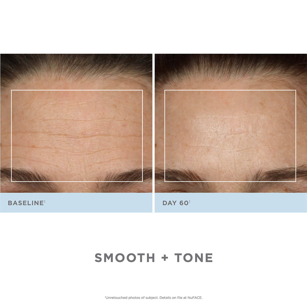 Trinity Facial Toning Device + Wrinkle Reducer Attachment Bundle N5993