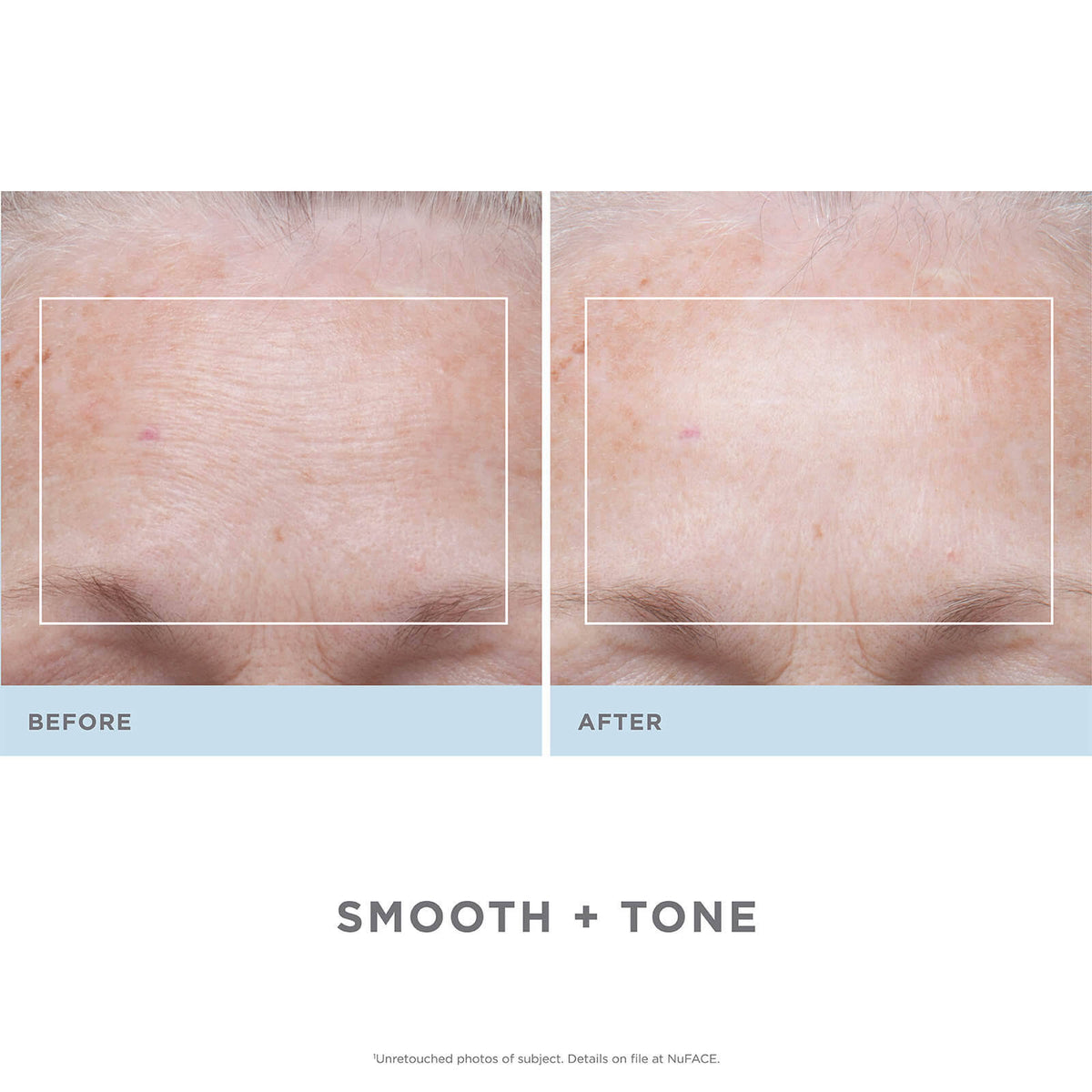 Trinity Facial Toning Device + Wrinkle Reducer Attachment Bundle N5993
